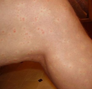 Cercariën dermatitis(7)